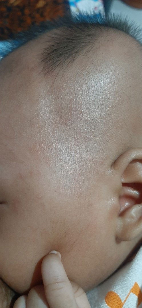 Merah² pada bayi 2 blan