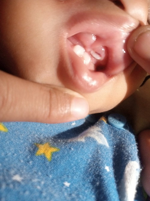Gigi bayi 10 bulan