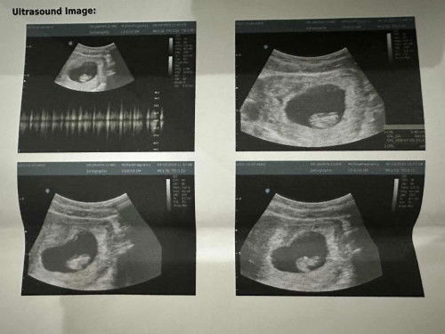 แม่ๆบ้านไหนถุงครรภ์ไม่ค่อยสวยบ้างค่ะแร้วท้องสำเร็จไหมคะ ส่วนตัวเคยแท้งเรยกังวลค่ะ🙏🏻