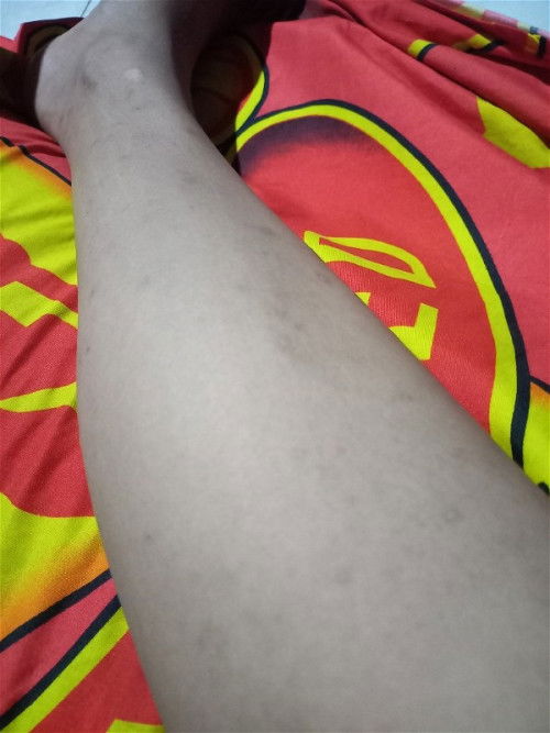 Tangan dan kaki gatal