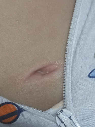 NAGNANANA BA SA LOOB NG PUSOD NI BABY? 4MONTHS OLD BOY.