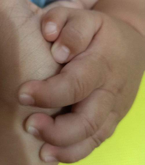 Extra finger/ thumb (polydactyly)