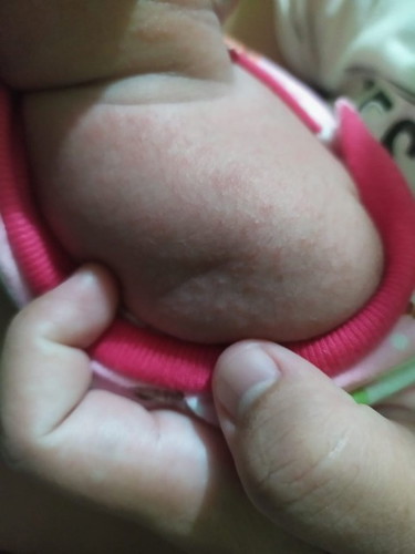 ruam pada bayi