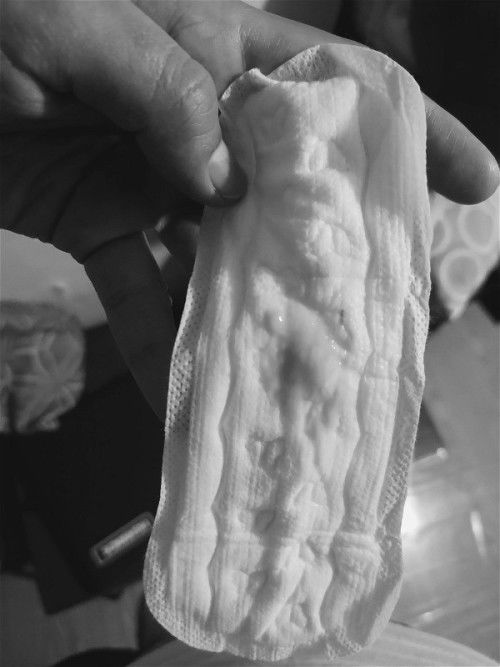 Slimy discharge with blood