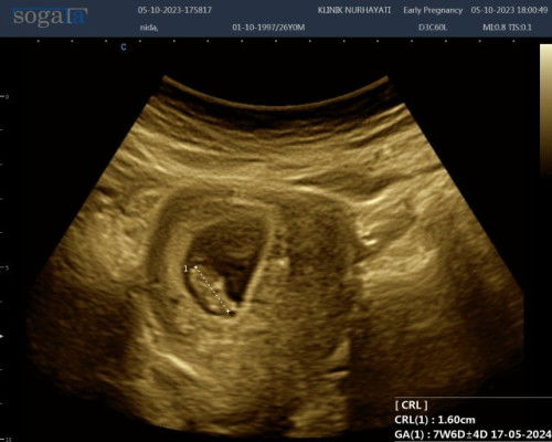 Beda Hpl USG dan HPHT