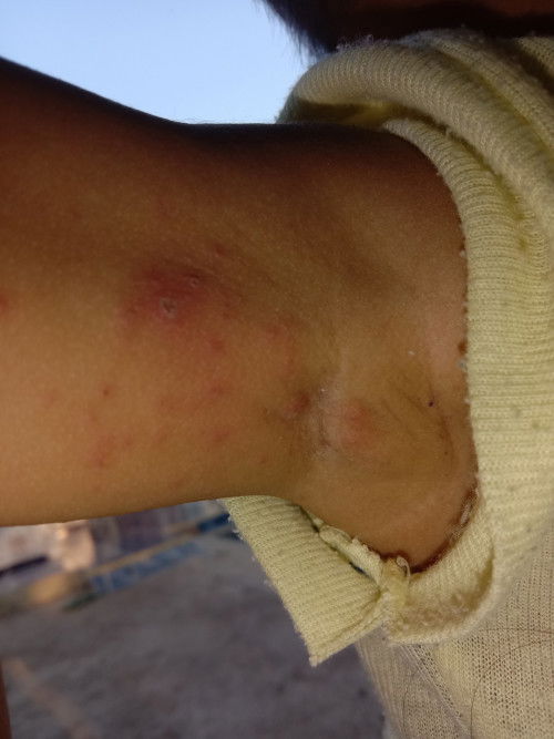 herpes atau apa ya ini?