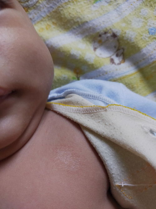 Kulit kering di bdn dan tangan