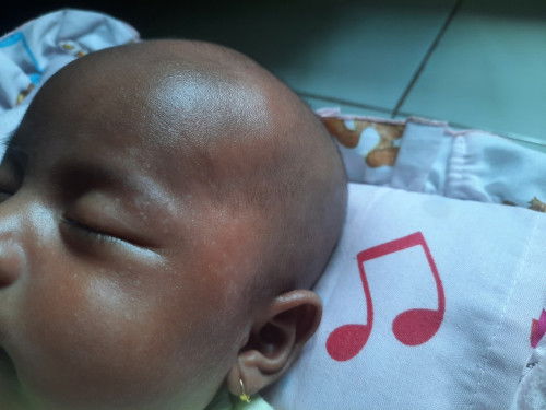 Bintik putih di wajah bayi