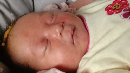 Kemerahan pada newborn