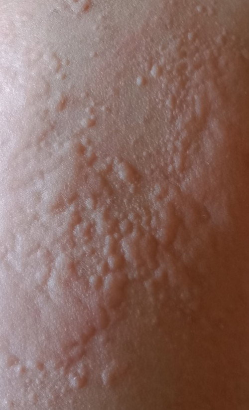 Gatal2 pasca melahirkan