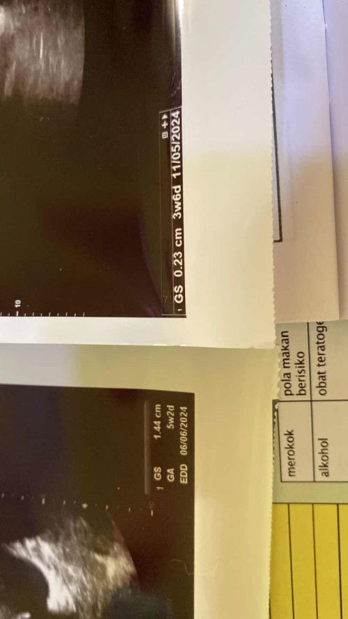 Selisih usg pertama sama kedua beda jauh