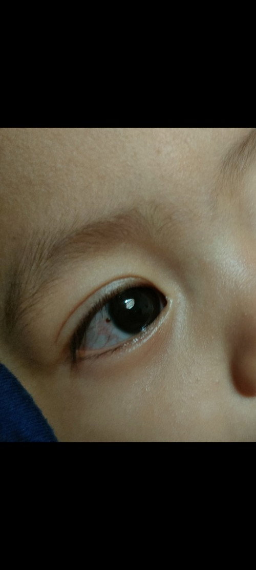 Tahi lalat dimata