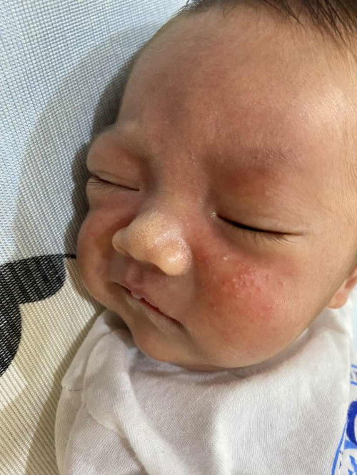 Bé nhà em bị nốt nước và đỏ như này, là bị sao vậy ạ? Bé lại hay quơ bao tay lên mặt nên trôi thuốc