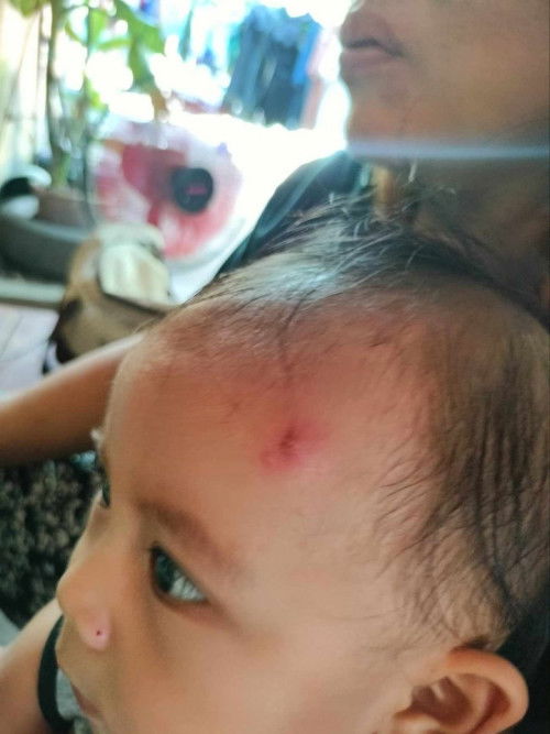 Parang pimple sa noo ng baby