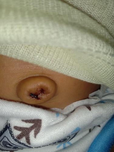 Anku usia 23hari tpi pusar blm kering.cara ngeringin pusar gmn y mom??
