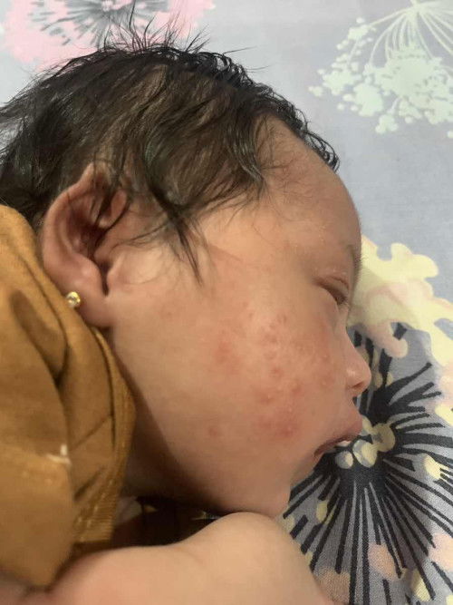 Ruam merah di pipi newborn