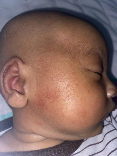 Bruntusan pada bayi 3minggu