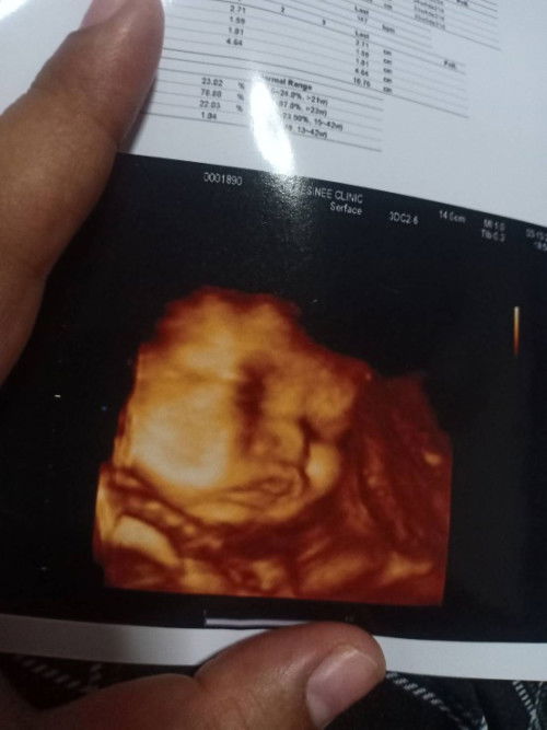 ท้องได้35+4 สายสะดือพันคอแม่บ้านเปนบ้างค่ะ หมอว่าไงบ้าง