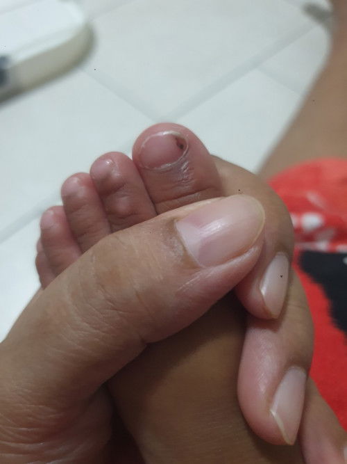 Brown spot on baby nails
