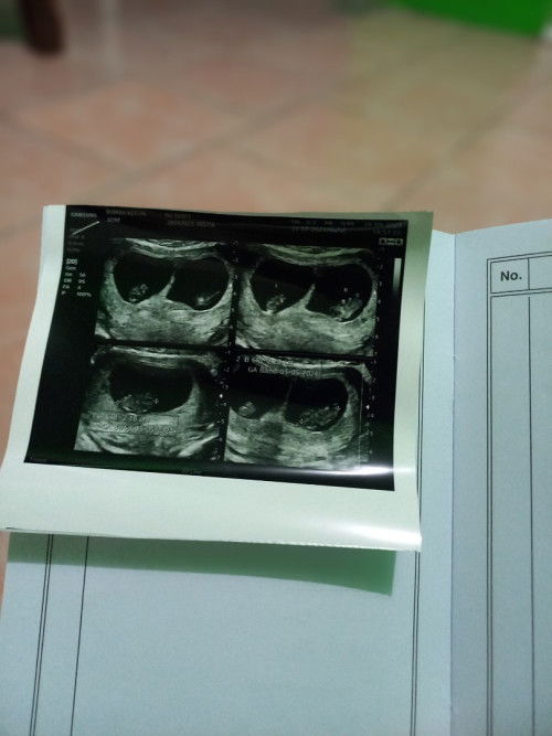 Hamil kembar 2 kantung