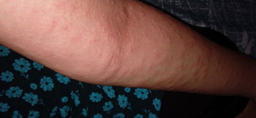 Gatal gatal Pd ibu menyusui