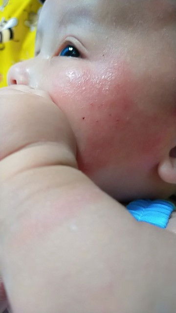 Pipi merah merah hampir 2 bulan belum sembuh2