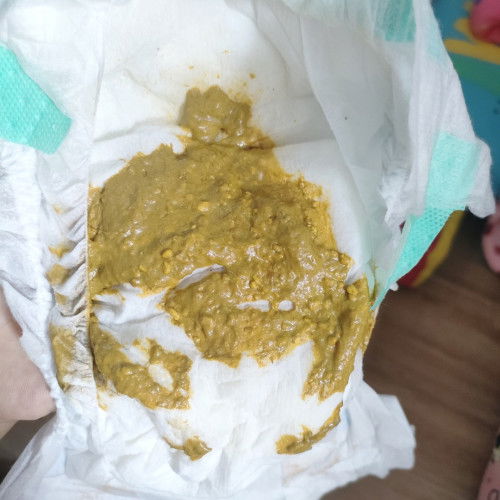 ขี้ไม่ออก +กินนมผง+นมแม่