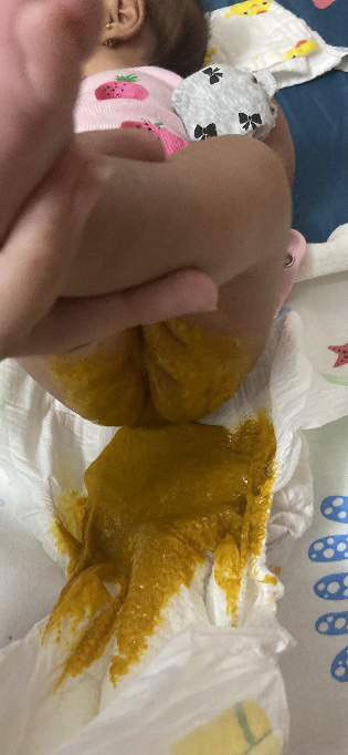 Mấy ngày mới đi ngoài 1 lần