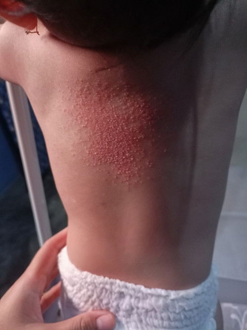 Bintik bintik merah di badan bayi umur 9 bulan