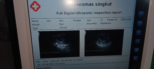 Kantung kehamilan lebih besar dari usia kehamilan.