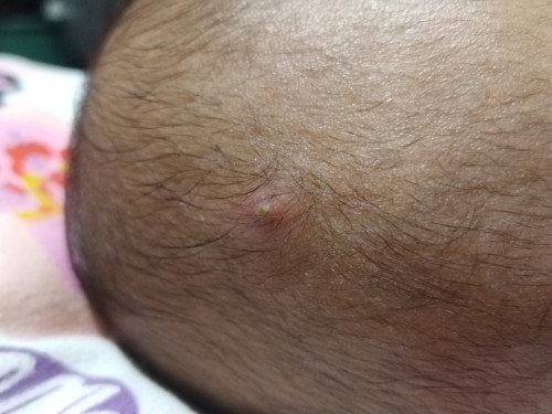 Mga momsh ano po kaya tong tumubo sa ulo ni baby delikado po ba ito malapit kasi sa bunbunan nya?