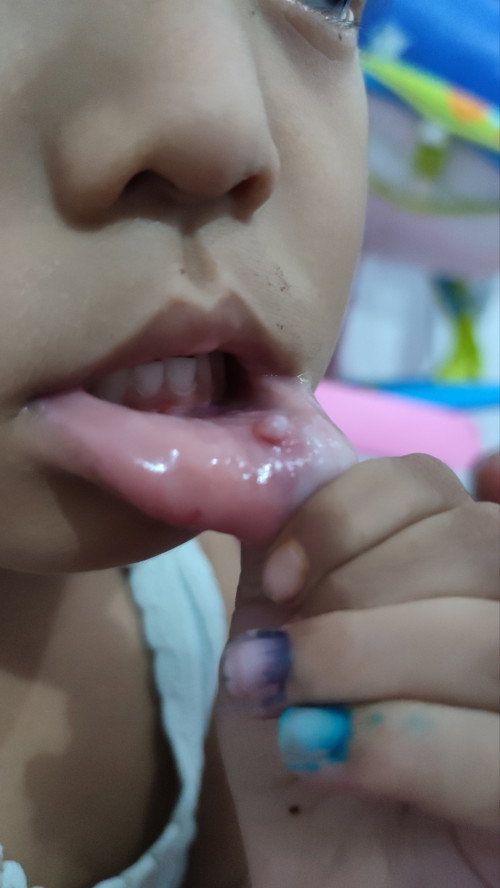 Benjolan dibibir