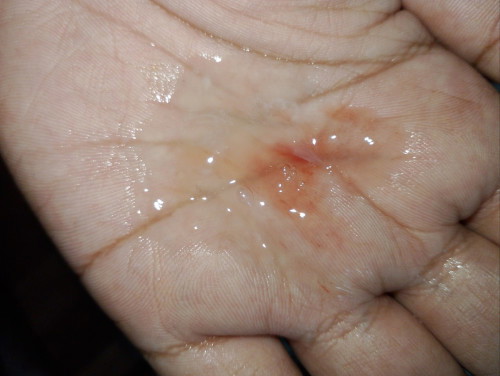 Keluar Lendir + Darah