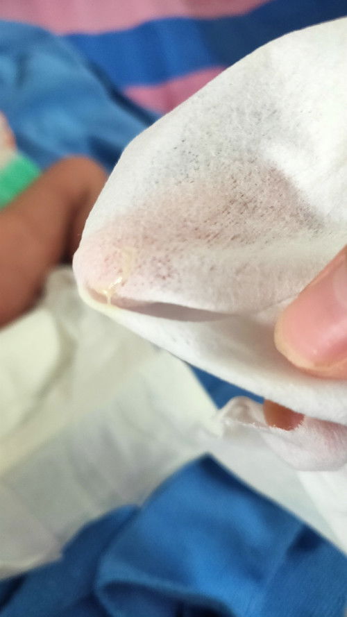 บางทีเปลี่ยนแพมเพิสให้น้องแล้วมีแบบนี้อะค่ะ