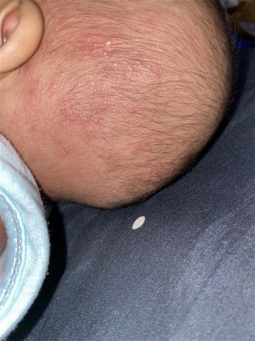 Apakah ini biang keringat?