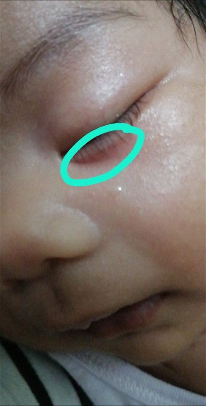 Pula sa ilalim ng mata ni baby