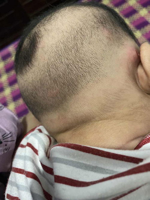 Semacam jerawat atau bisul