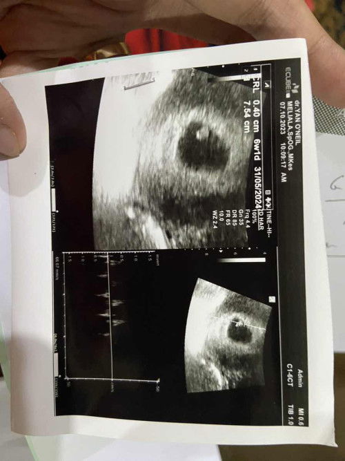 Hamil 6 week HPHT 15 agustus