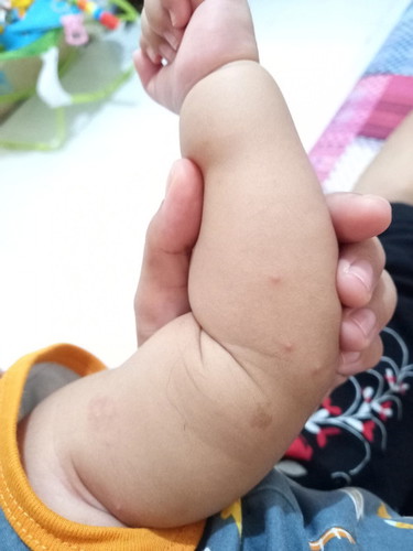 Bayiku 3 bln abis imunisasi, demam. Demamx sembuh kena flu dan batuk. Muncul bintik2 merah. Samaan ?