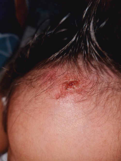 Hello po ! baka lang po may naka experience ng ganito . ano po ginamot nyo ?