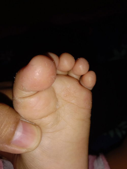 Kulit mengelupas dikaki kenapa yah bun ? Ksian kulit telapak kkinya kering juga ..