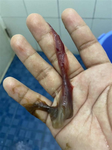 Mucus Plug