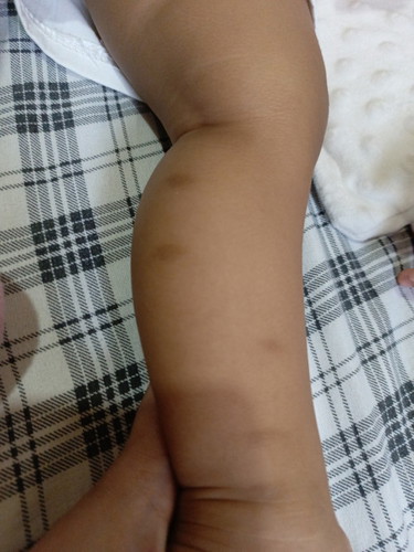Peklat sa binti ni baby