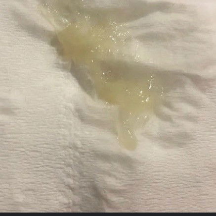 các mom cho e hỏi có phải dịch này là e bị bung nút nhầy rồi phải ko ạ?