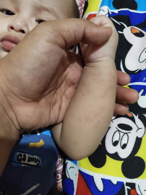Bintik" dan bentol merah pada kaki & tangan