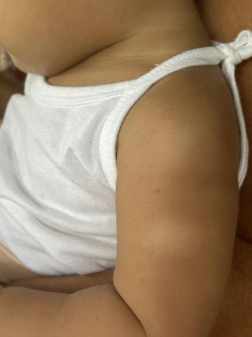 White marks and spots sa katawan ni baby