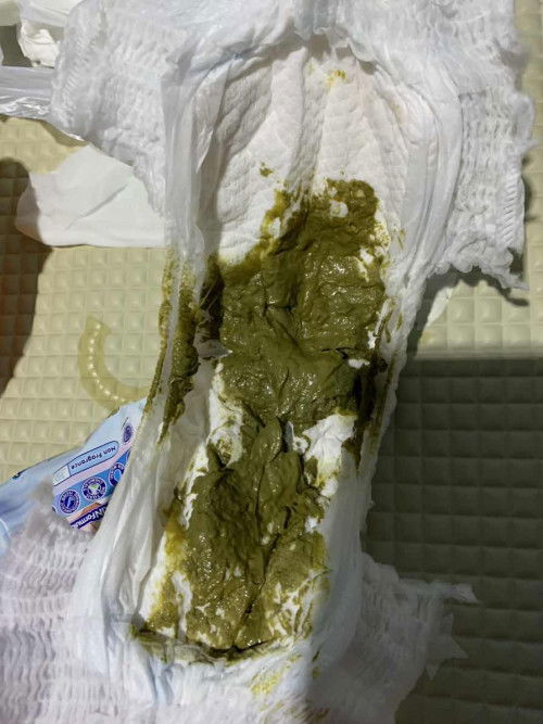 Bayi jarang BAB (ASI mix sufor)