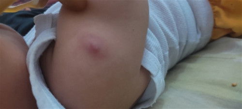 Imunisasi bcg bisul merah