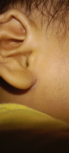 Daun telinga bagian bawah nya sakit dan gatal, dikasih obat/salep apa ya?Anak usia 1tahun lebih.