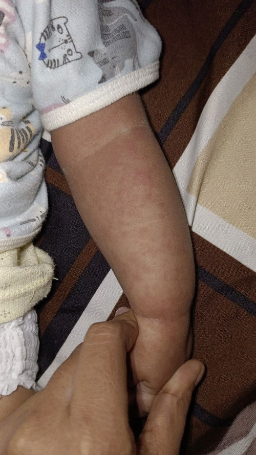 Hallo bund, kira kira ini anakku kenapa ya. Ini d sertai demam juga padahal usia nya br 5bulan